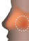 Nasal Polyps, Asthma, Allergies & Sinusitis