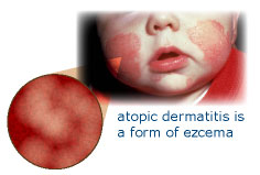 Atopic Dermatitis