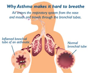 Anatomy of an Asthma Attack