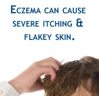 Common Symptoms of Eczema