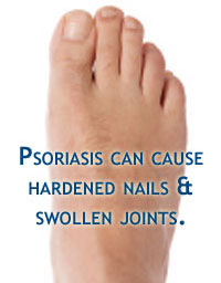 Common Causes of Psoriasis