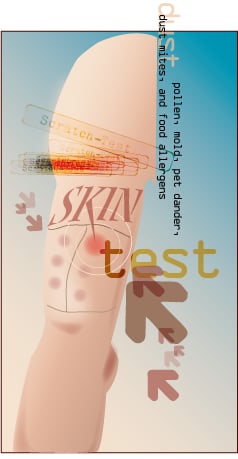 Skin Testing for Allergies